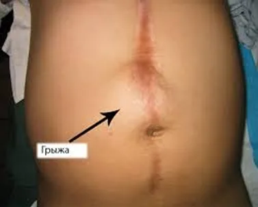 posleoperatcionnaia_gryzha_briushnoi_polosti