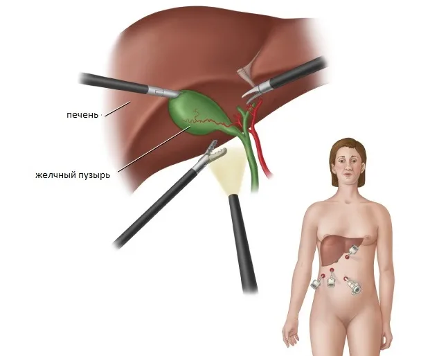 lechenie_holesticita.jpg