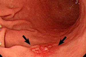 razmer_opuholi_2sm.jpg