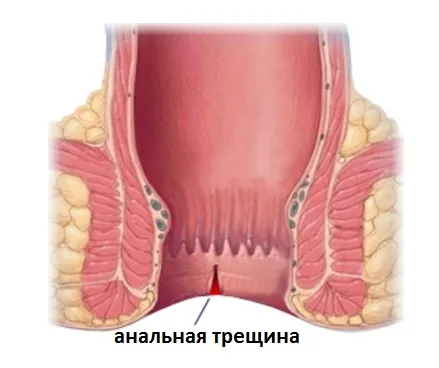 analnaya_treshina.jpg
