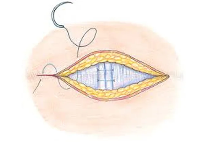 natiazhnaia_gernioplastika.jpg