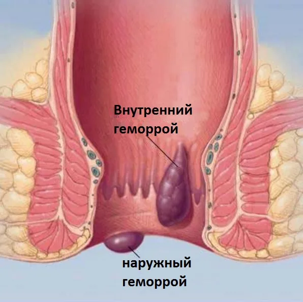 gemorroi-1.jpg