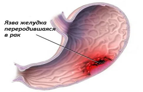 yazva_pererogdenie_v_rak.jpg