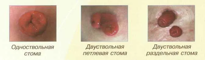 tipy_koloastom.jpg