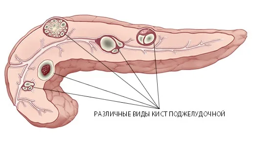 podgeludochnaya_2.jpg