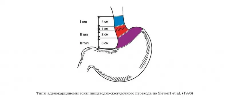 Типы аденокарциномы пищеводно-желудочного перехода по Siewert te al. (1996)