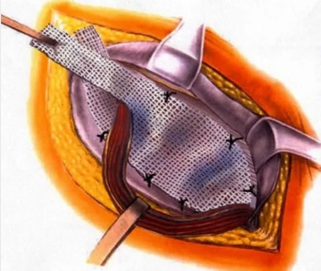 otkritaya_gernioplastica-1.jpg