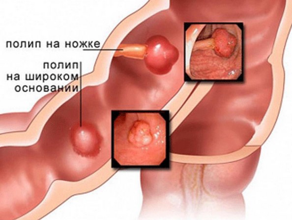 Полип стенки желчного пузыря пункция жидкости из брюшной полости