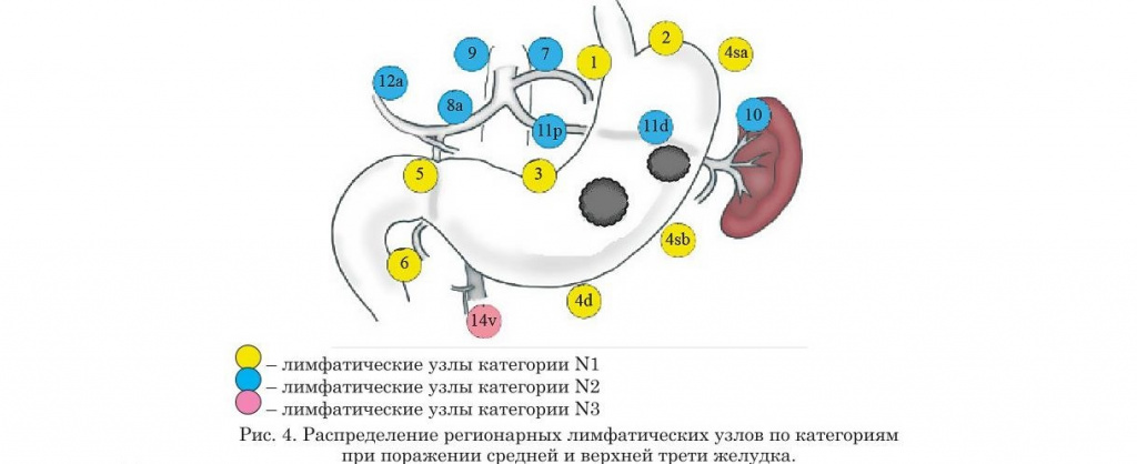 Распределение регилнальных лимфотических узлов по категориям при поражении средней и верхней трети желудка