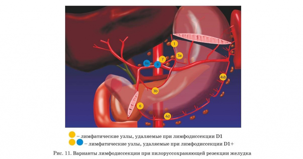Варианты лимфодиссекции при пилоруссохраняющей резекции желудка