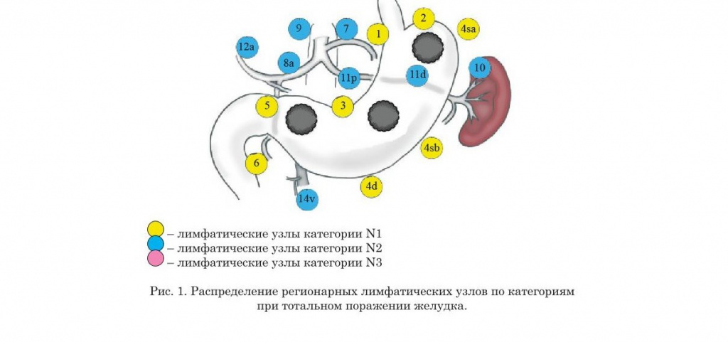 Распределение регионарных лимфатических узлов желудка по категориям
